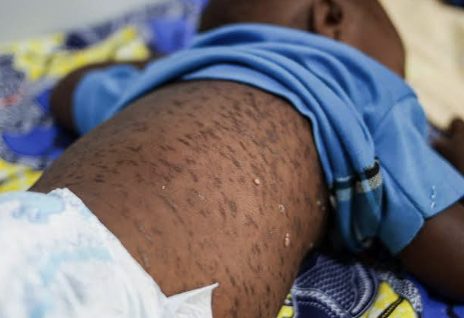 DPH Confirms Five Additional Measles Cases in Georgia