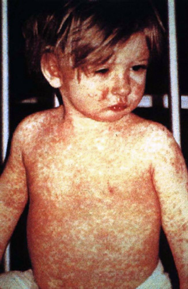 Measles Cases Climb to 21 in Georgia: What Columbus Parents Should Know