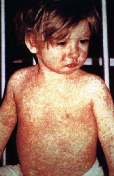 Measles Cases Climb to 21 in Georgia: What Columbus Parents Should Know